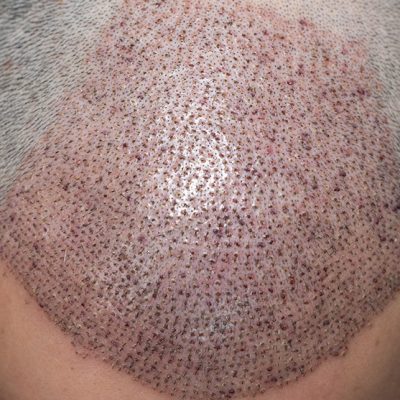 Which-Hair-Transplant-Technique-Is-Best-For-You-To-Learn