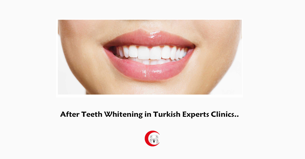 After-Teeth-whitening