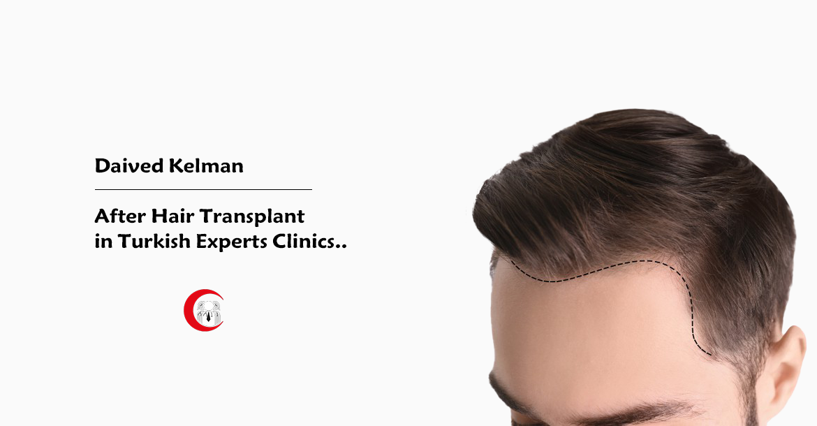 After-Hair-Tranplant