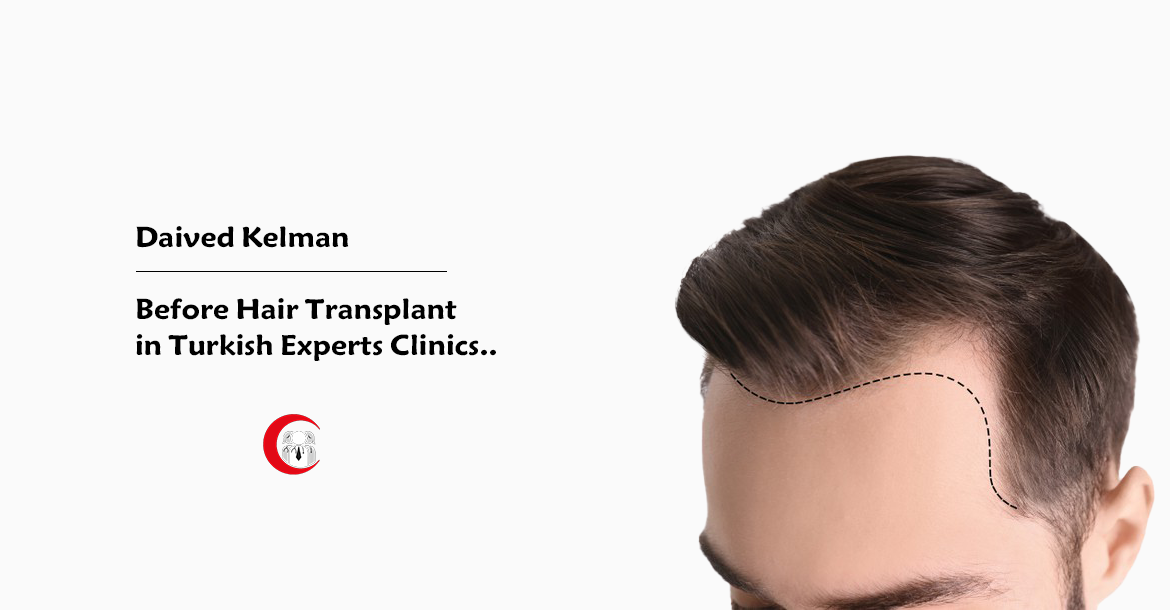 Before-Hair-Tranplant