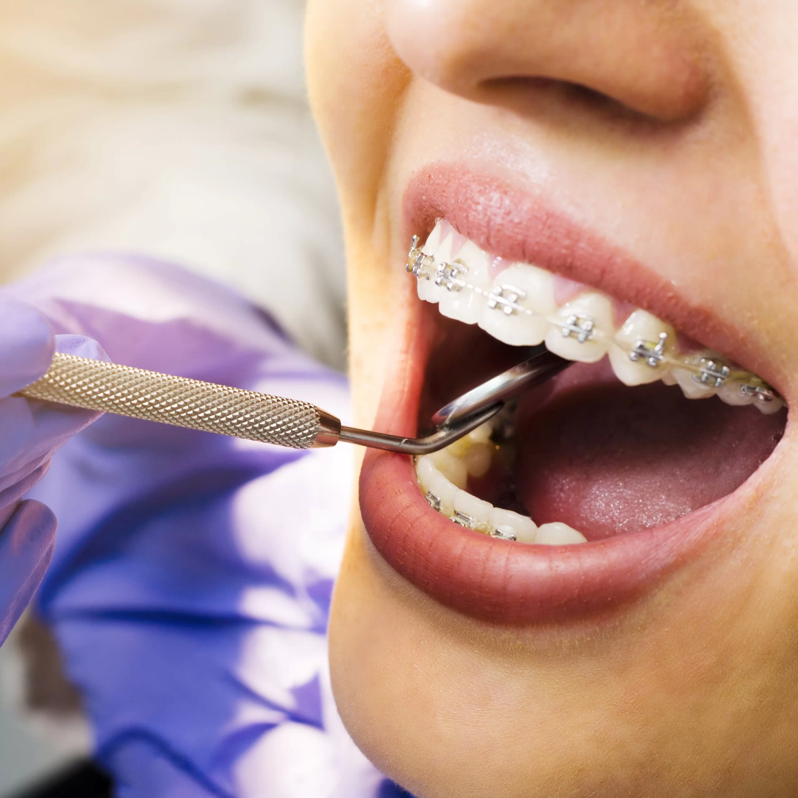 Teeth Treatment