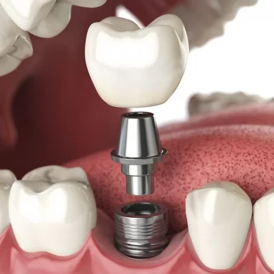 dental-implants-1920x960